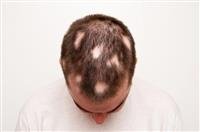 Mouse study finds immune system could promote hair