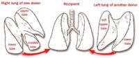 Who Needs a Lung Transplant?