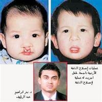 Cleft lip surgeries