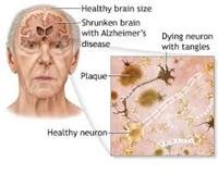 What is Alzheimer's Disease?