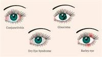 Types of Dry Eye