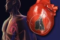 A Visual Guide to a Heart Attack