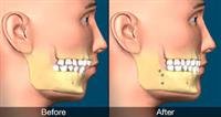 Types of Jaw Surgery and the Reasons for Each