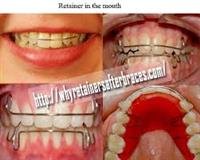 Dental Braces and Retainers