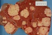What Is a Colorectal Surgeon?