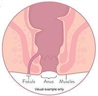 Fistulas