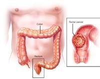 Rectal cancer
