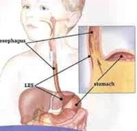 GERD in Children