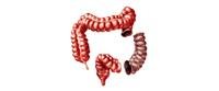 Colectomy side effects