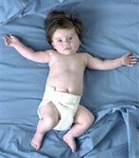 U.S. Circumcision Rates Drop by 10 Percent: CDC