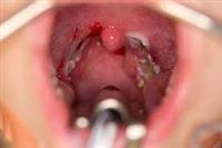 Does My Child Need a Tonsillectomy?