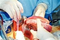Liver transplantation.