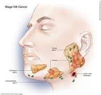 Childhood Cancer