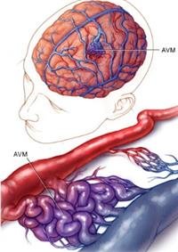 Brain AVM (arteriovenous malformation)