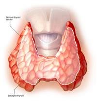 Hyperthyroidism (overactive thyroid)