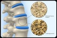 Vitamin D for Osteoporosis