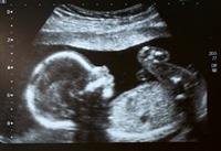 Small fetal size in pregnancy