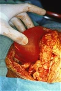 organs transplantation