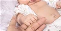 Umbilical hernia in children.