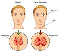 Underactive Thyroid Gland