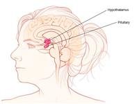 Hypopituitarism