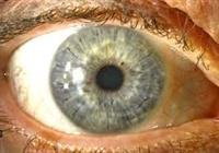 LASIK After Radial Keratotomy