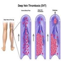 Cure for Deep Vein Thrombosis?