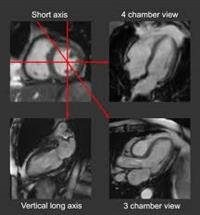 What Is Cardiac MRI?