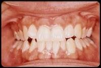 Habits That Wreck Your Teeth