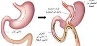 Gastric bypass.