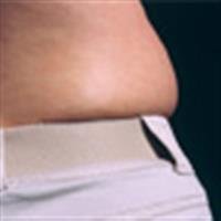 Considering Gastric Bypass Surgery?