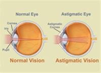 Refractive Errors